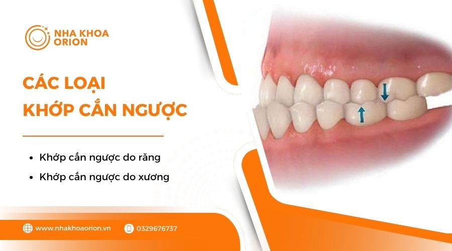 Các loại khớp cắn ngược