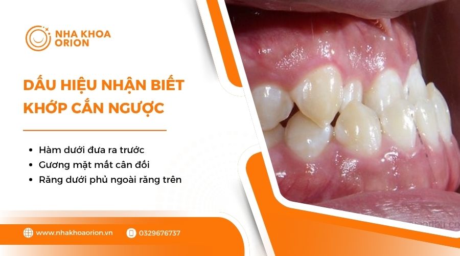 Dấu hiệu nhận biết khớp cắn ngược