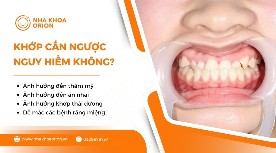 Khớp cắn ngược có nguy hiểm không?