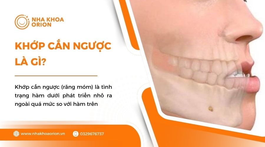 Khớp cắn ngược là gì?