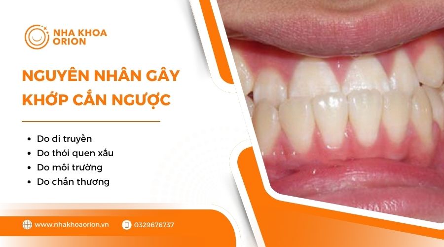 Nguyên nhân gây khớp cắn ngược
