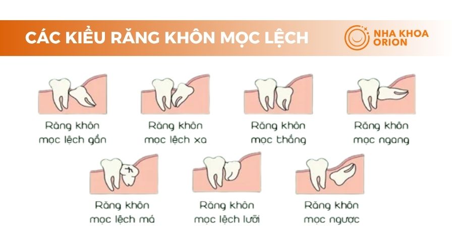 Các kiểu mọc lệch của răng khôn