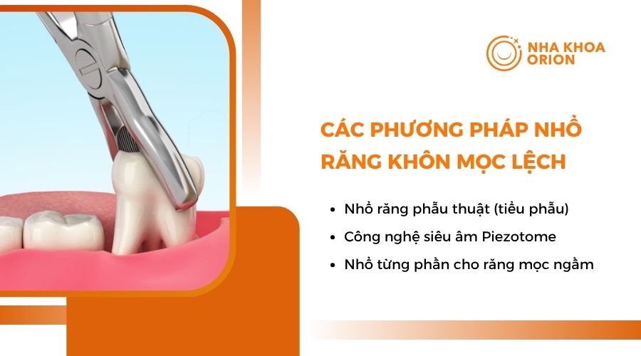 Các phương pháp nhổ răng khôn mọc lệch
