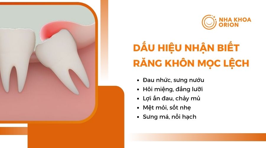 Dấu hiệu răng khôn mọc lệch