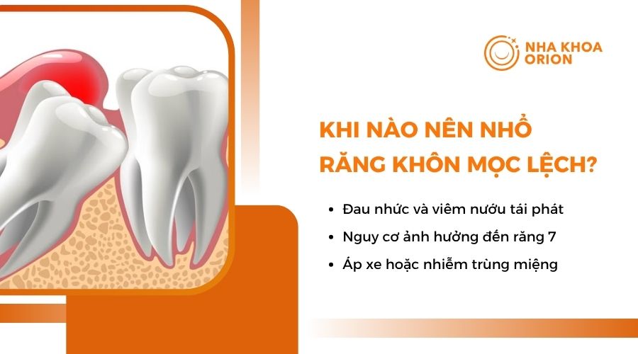Khi nào nên nhổ răng khôn mọc lệch?