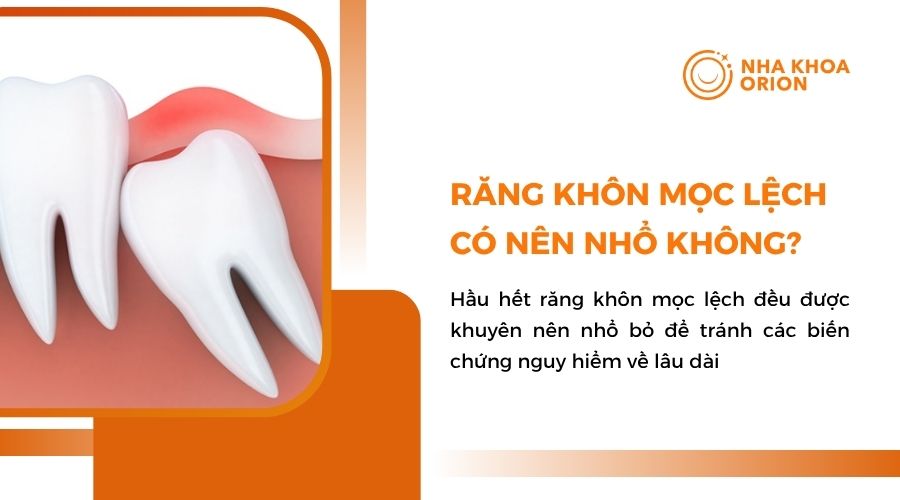 Răng khôn mọc lệch có nên nhổ không?