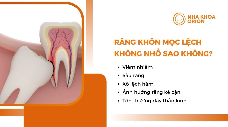 Răng khôn mọc lệch không nhổ có sao không?