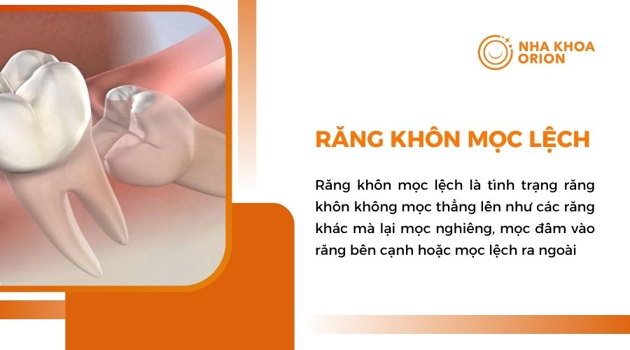 Răng khôn mọc lệch là gì?