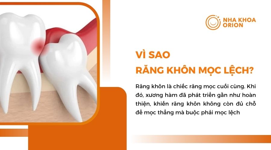 Vì sao răng khôn mọc lệch?