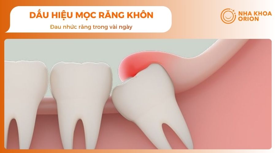 Đau nhức răng là dấu hiệu khi mọc răng khôn 