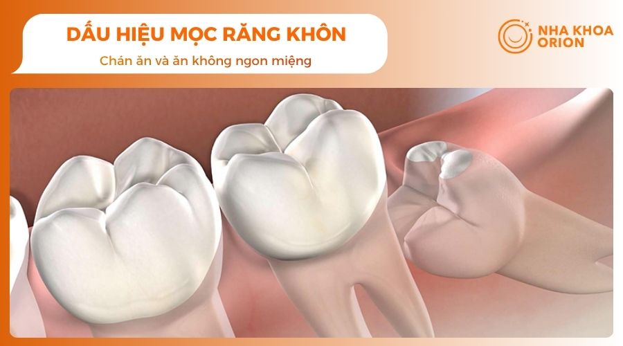 Mọc răng khôn làm việc ăn uống trở nên khó khăn