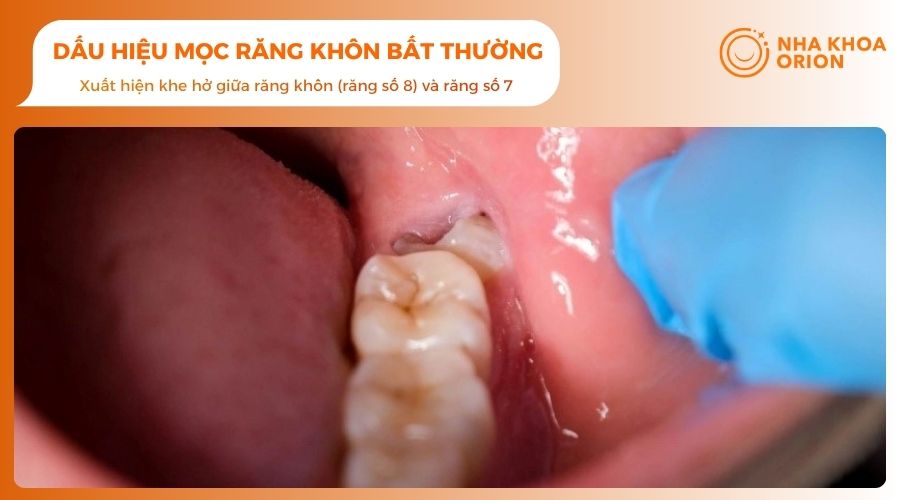 Dấu hiệu mọc răng khôn bất thường cần đi khám
