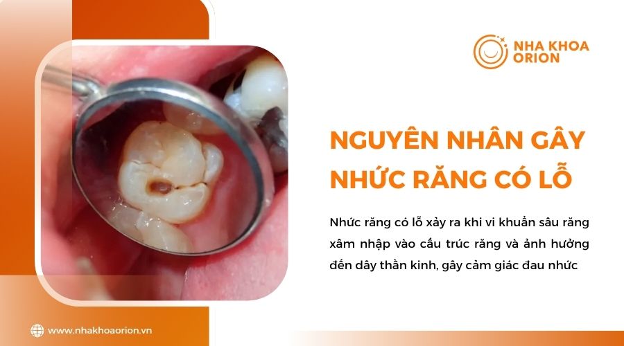 Nguyên nhân gây nhức răng có lỗ