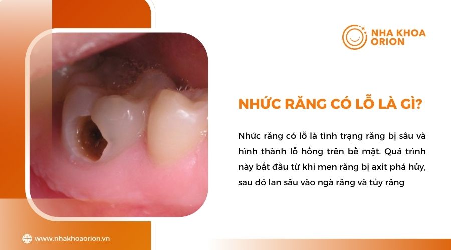 Nhức răng có lỗ là gì?