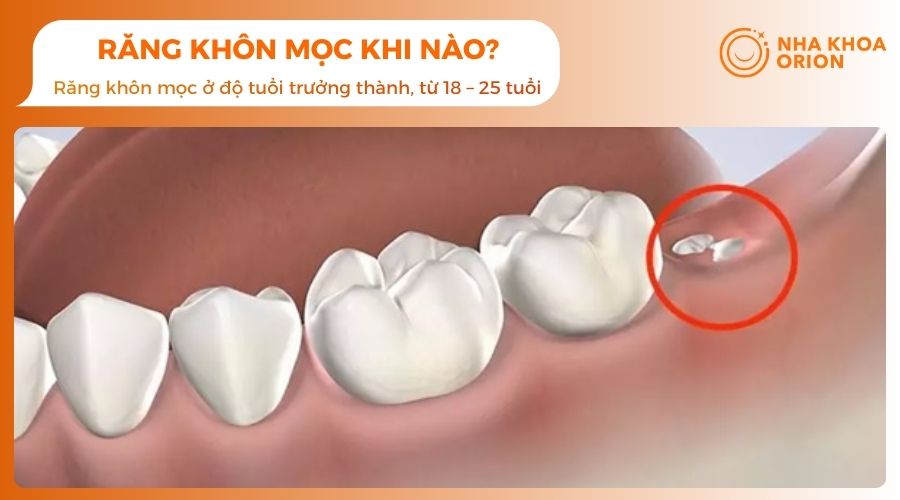 Răng khôn mọc khi nào?