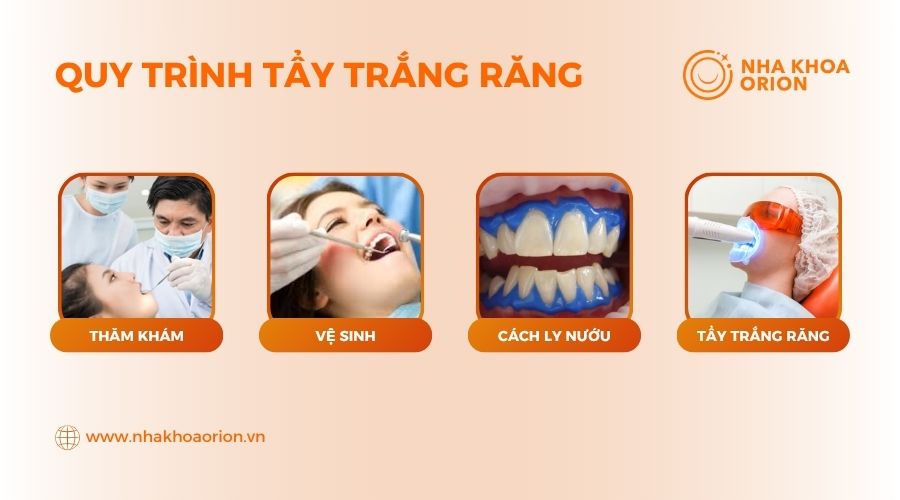 Quy trình tẩy trắng răng tại Nha Khoa Orion quận 9