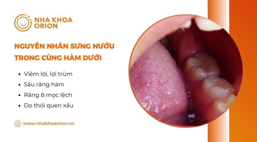 Nguyên nhân gây sưng nướu răng trong cùng hàm dưới