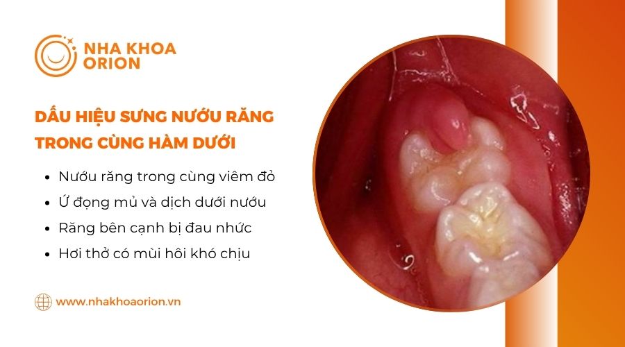 Những dấu hiệu sưng nướu răng trong cùng hàm dưới