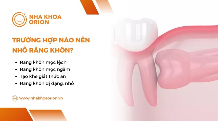 Trường hợp n&agrave;o n&ecirc;n nhổ răng kh&ocirc;n