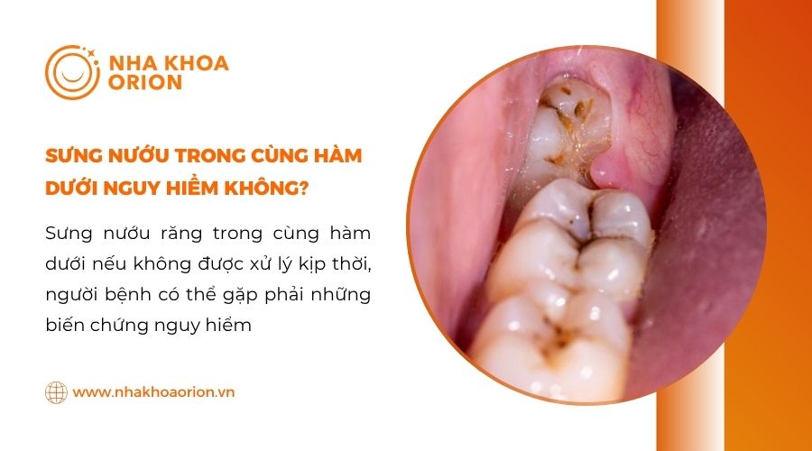 Sưng nướu răng trong cùng hàm dưới có nguy hiểm không?