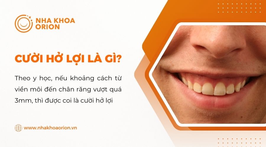 Cười hở lợi l&agrave; g&igrave;?