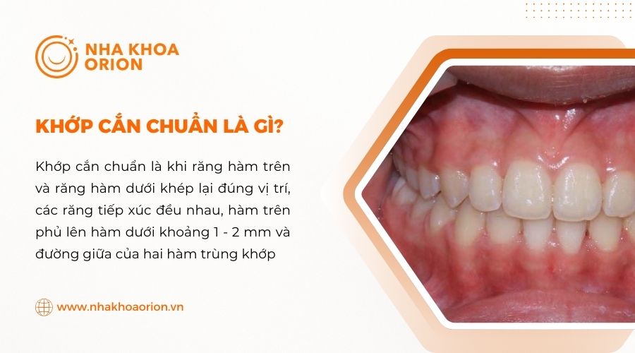 Khớp cắn chuẩn là gì?