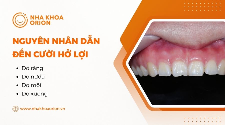 Nguy&ecirc;n nh&acirc;n dẫn đến cười hở lợi