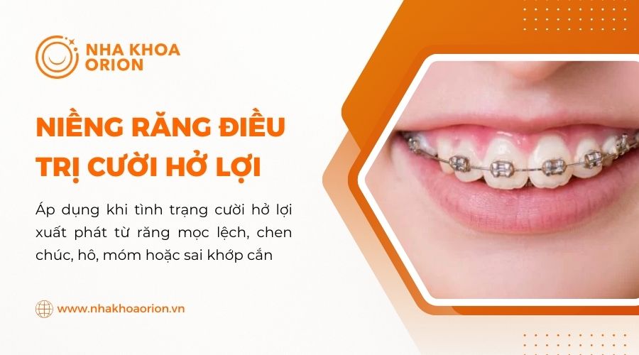 Niềng răng c&aacute;ch khắc phục cười hở lợi