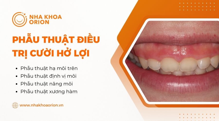 Phẫu thuật điều trị cười hở lợi