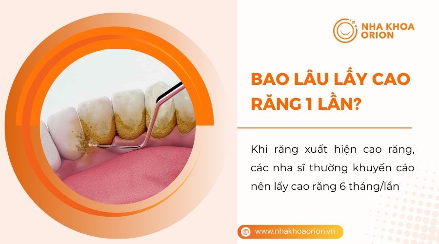 Bao lâu lấy cao răng 1 lần?