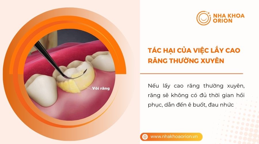 Tác hại của việc cạo vôi răng thường xuyên