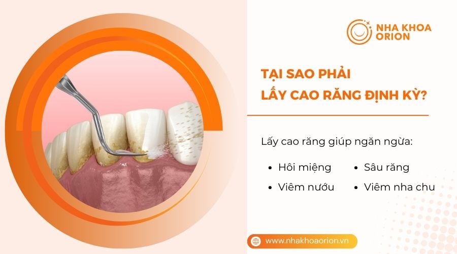 Có nên lấy cao răng không?