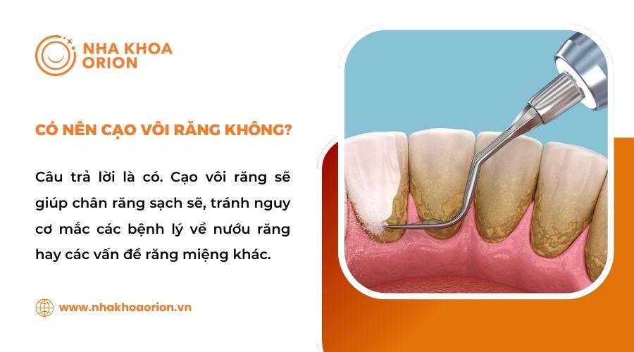 Giải đáp có nên cạo vôi răng không