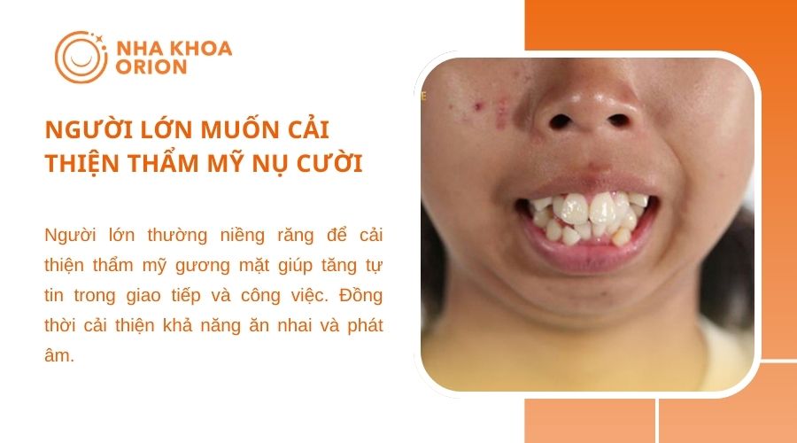 Người lớn muốn cải thiện thẩm mỹ nụ cười