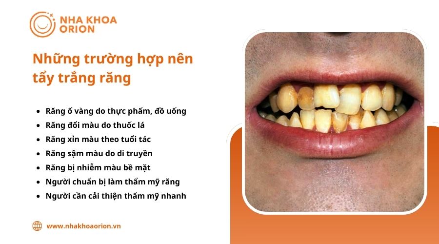 Những trường hợp nên tẩy trắng răng 