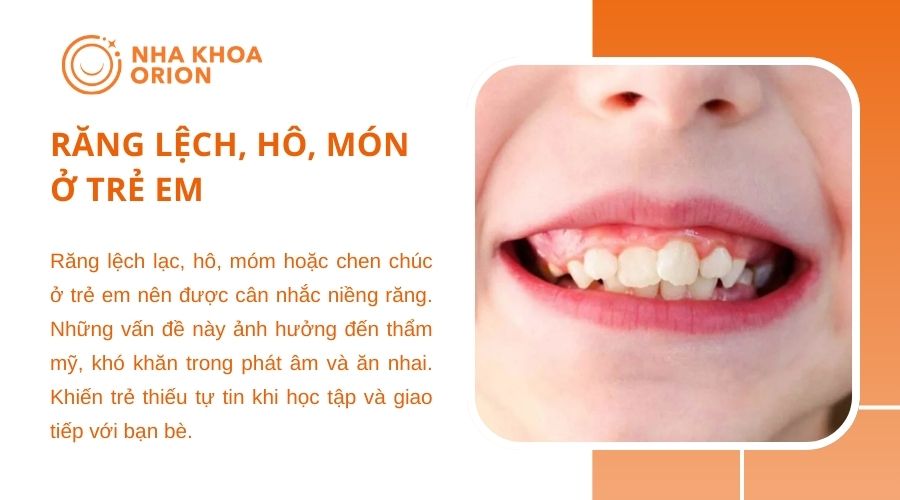 Răng lệch, hô, món ở trẻ em