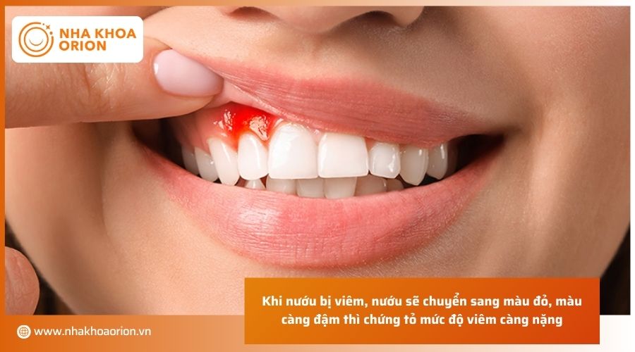 Dấu hiệu nhận biết viêm lợi