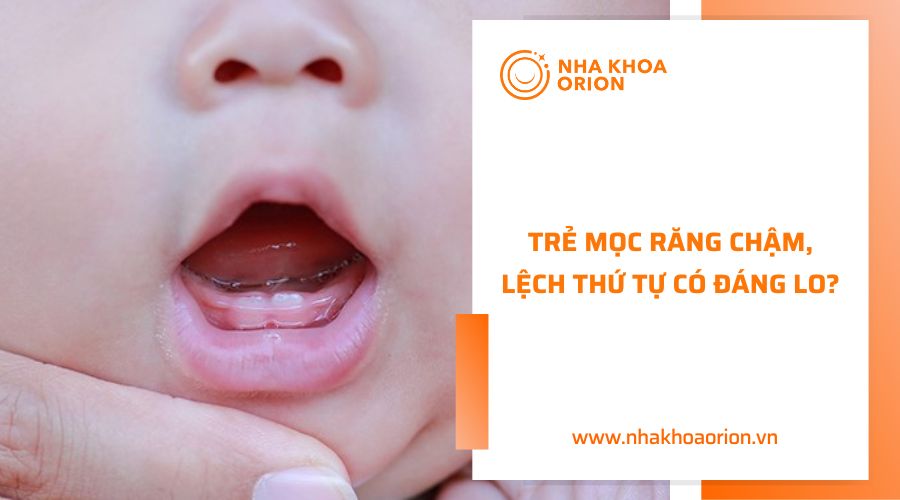 Không cần quá lo lắng khi trẻ mọc răng chậm, lệch thứ tự