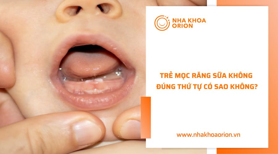 Trẻ mọc răng sữa không đúng thứ tự là điều bình thường