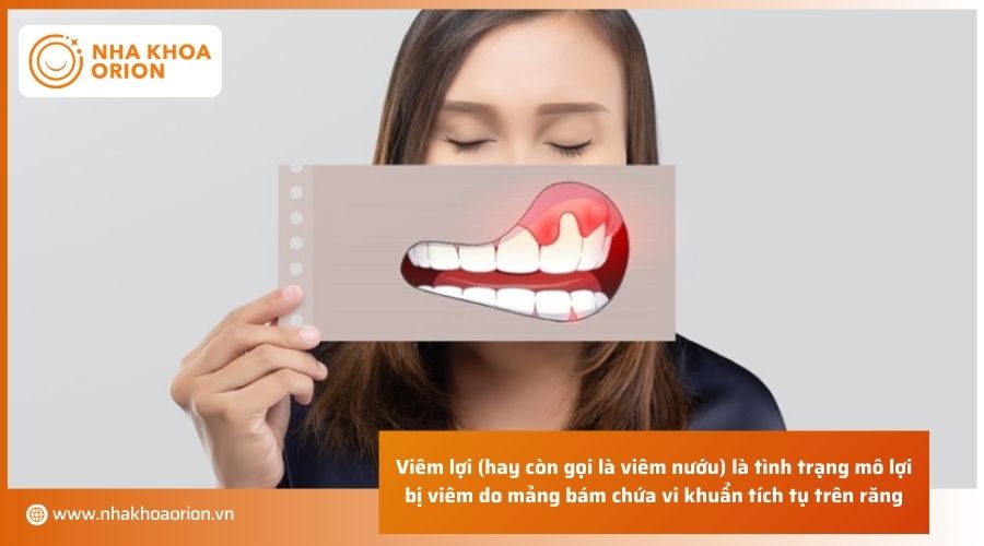 Viêm lợi là gì?