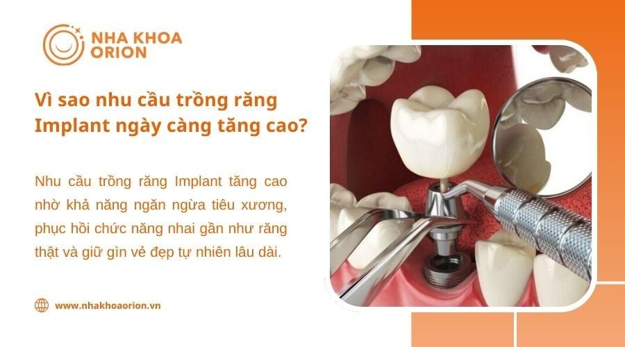 Lý do nên trồng răng Implant
