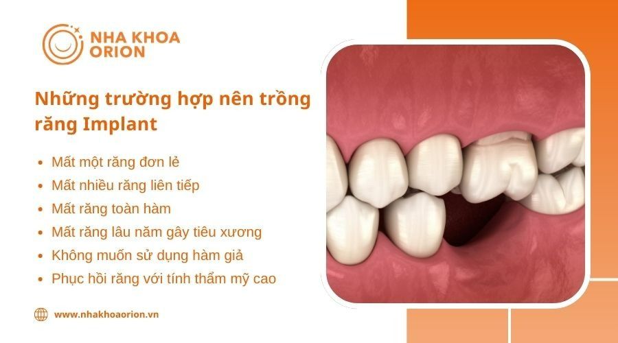 Những trường hợp nên trồng răng Implant