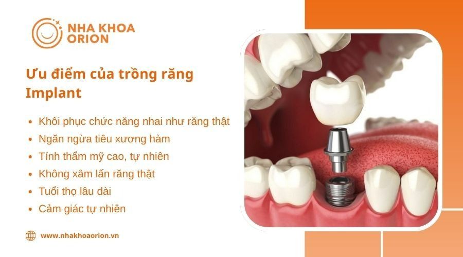 Ưu điểm của phương pháp trồng răng Implant