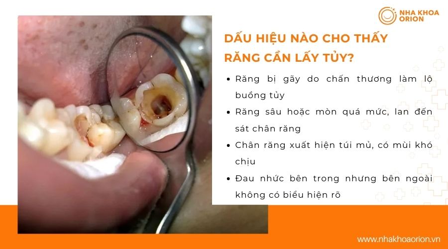 Dấu hiệu nào cho th&acirc;́y răng cần lấy tủy?
