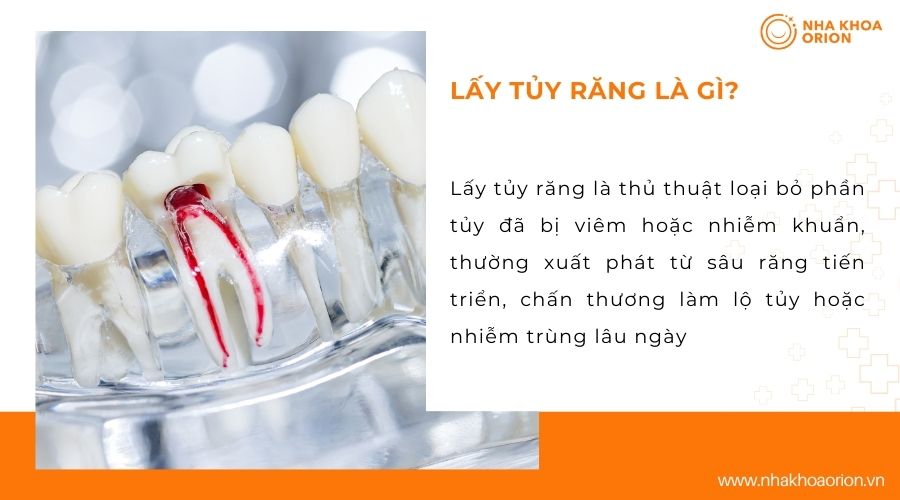 L&acirc;́y tủy răng l&agrave; g&igrave;?