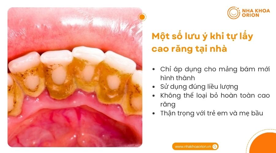 M&ocirc;̣t s&ocirc;́ lưu ý khi tự lấy cao răng tại nh&agrave;