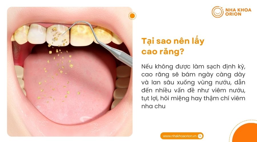 Tại sao n&ecirc;n l&acirc;́y cao răng?