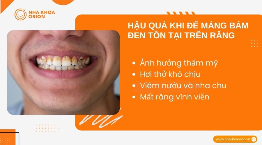 Hậu quả khi để mảng b&aacute;m đen tồn tại tr&ecirc;n răng