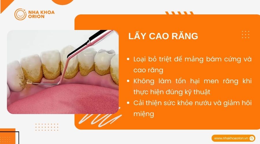 Loại bỏ mảng b&aacute;m đen tr&ecirc;n răng bằng c&aacute;ch lấy cao răng