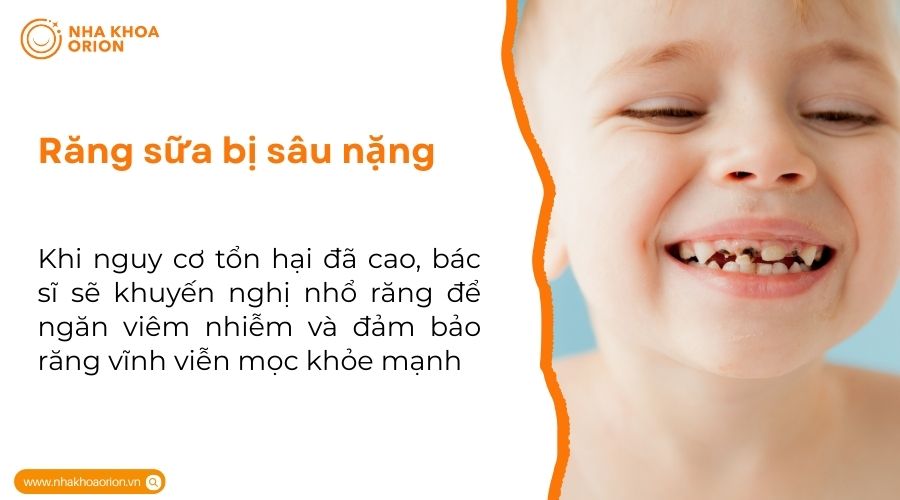 Răng sữa bị s&acirc;u nặng